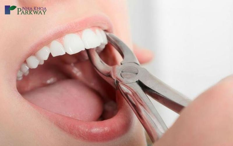cách trị xiết ăn răng ở người lớn tại nhà