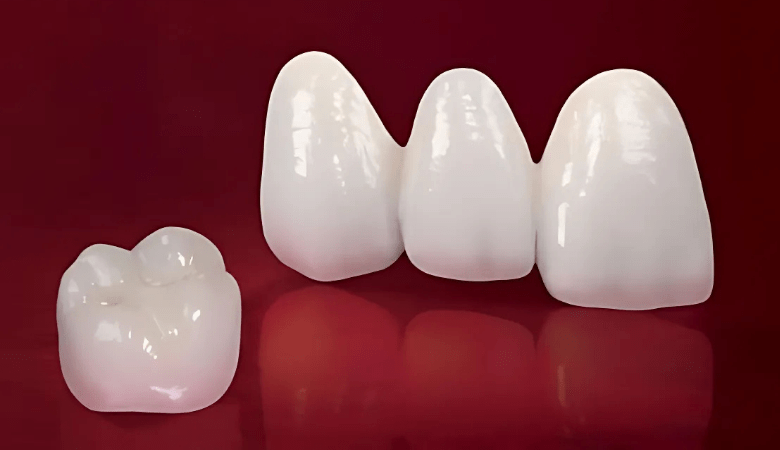 răng sứ toàn sứ là gì