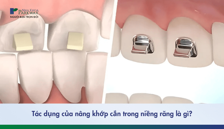 Tác dụng của nâng khớp cắn trong niềng răng là gì