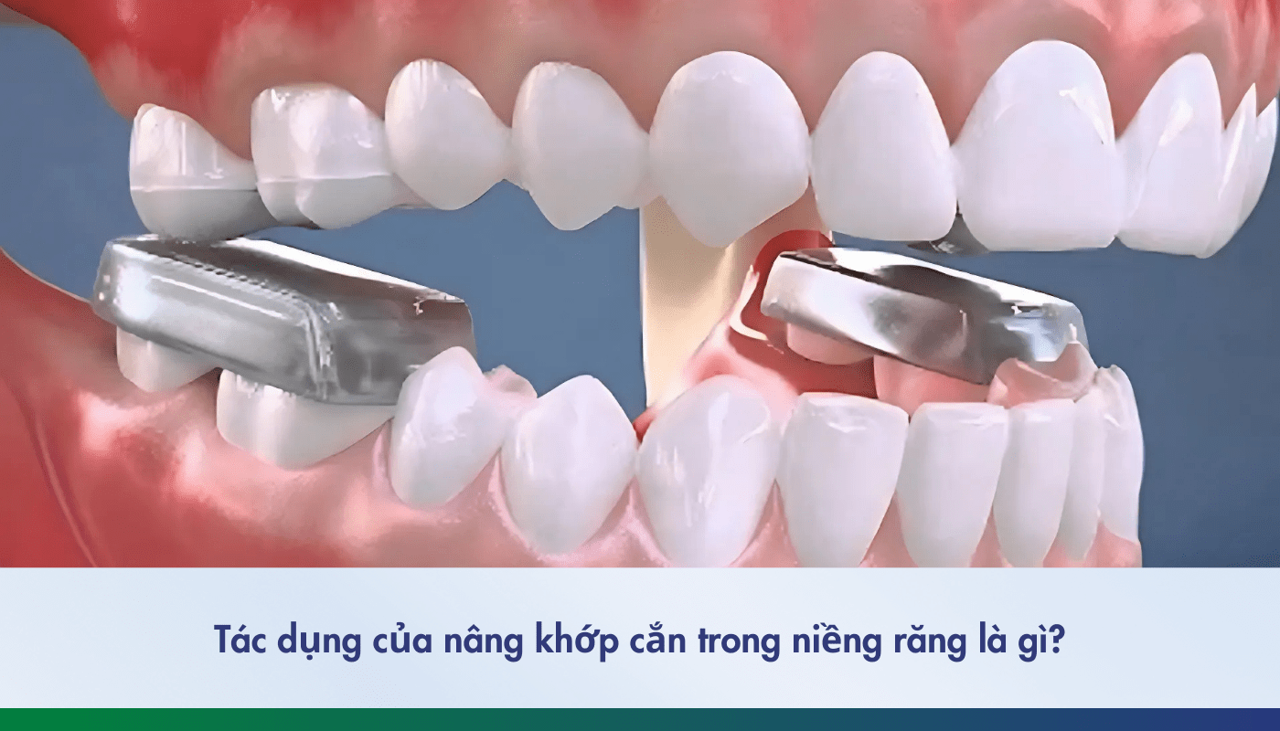 Nâng khớp cắn khi niềng