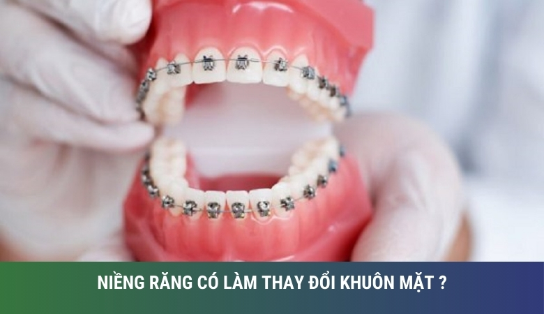 Niềng răng có làm thay đổi khuôn mặt không - 1