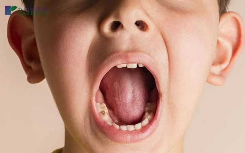 răng trẻ bị xiết ăn