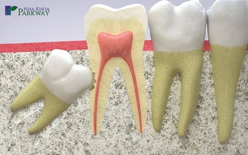 biến chứng nhổ răng khôn hàm dưới có nguy hiểm không