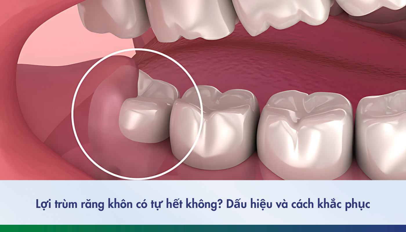 Lợi trùm răng khôn - 1