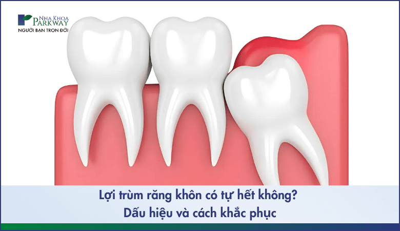 Lợi trùm răng khôn có tự hết không
