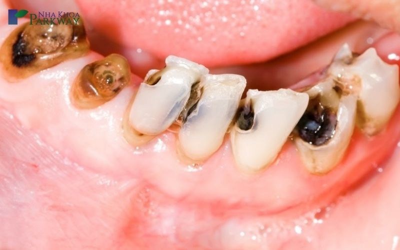nhổ răng khôn hàm trên bao lâu thì lành