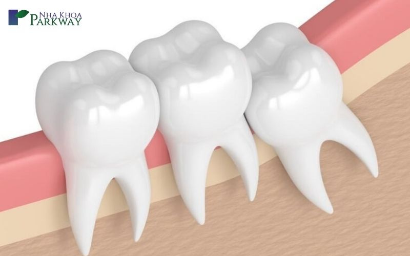 tiểu phẫu răng khôn có ảnh hưởng tới sức khỏe không