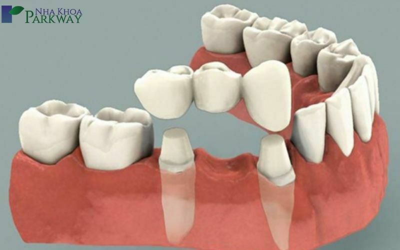 Bọc răng sứ bắc cầu an toàn hay không còn phụ thuộc vào các yếu tố như chất liệu răng sứ