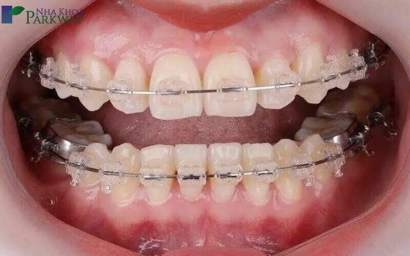 Dấu hiệu nhận biết niềng răng hỏng