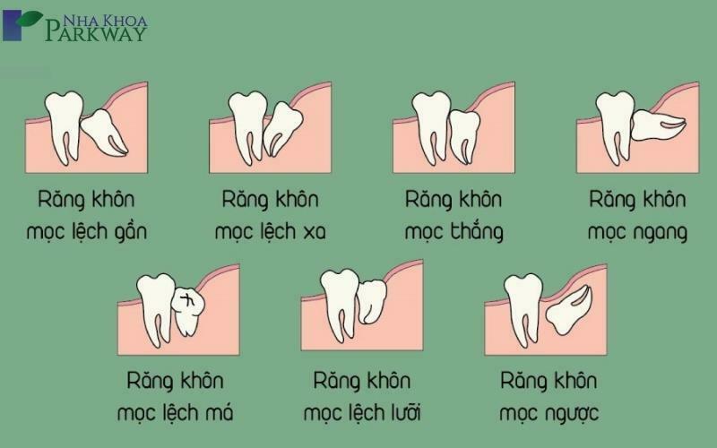 Một số tình trạng thường gặp khi mọc răng khôn