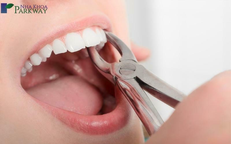Một vài trường hợp răng mọc ngầm còn gây nên các biến chứng nguy hiểm