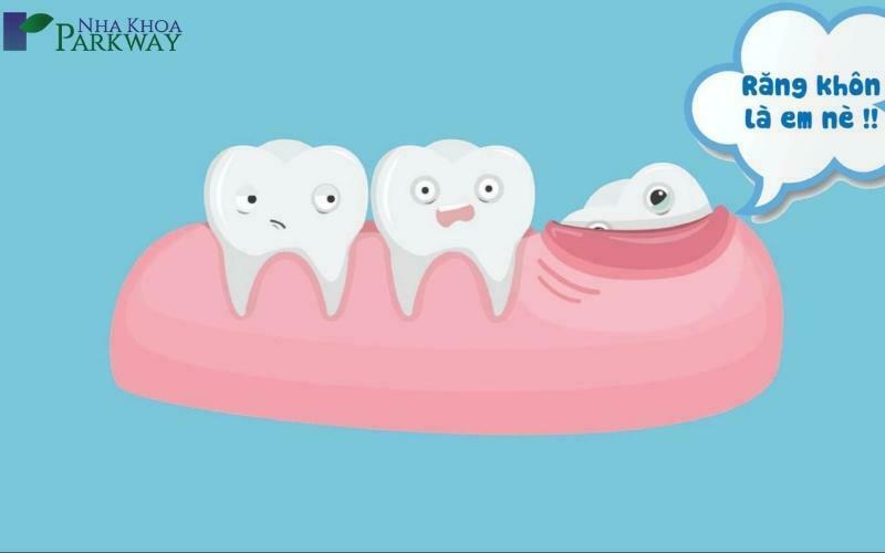 Răng khôn là gì? Các biểu hiện thường gặp nếu bạn mọc răng khôn