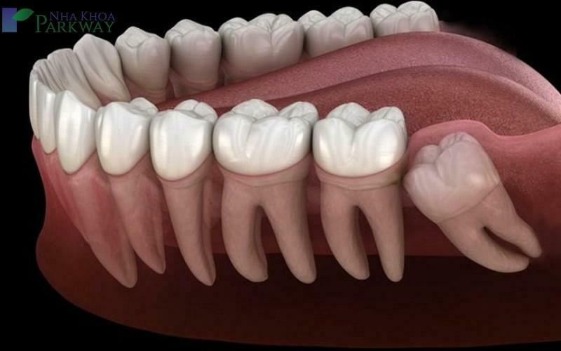 Răng số 8 sẽ không gây hại đến sức khoẻ nếu như mọc bình thường