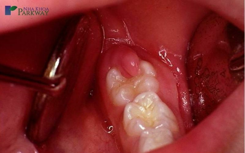 Sưng nướu răng trong cùng hàm dưới là tình trạng răng miệng bị viêm