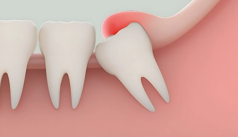 Dấu hiệu mọc răng khôn 