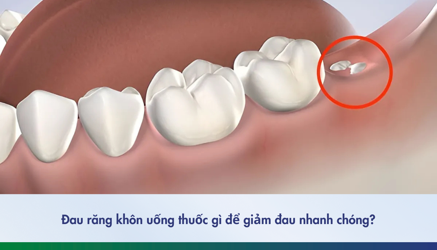 Đau răng khôn uống thuốc gì giảm đau nhanh