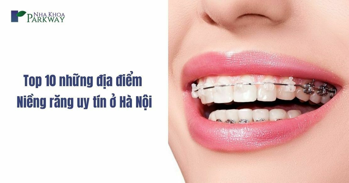Top 10 những địa điểm niềng răng uy tín ở Hà Nội