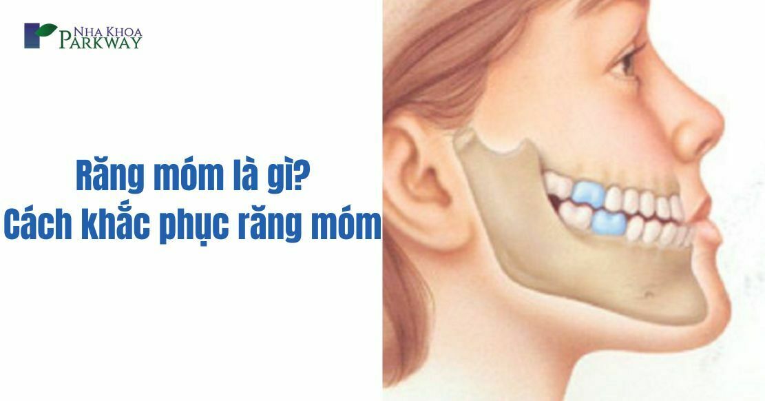 Răng móm là gì và 4 cách khắc phục răng móm tốt nhất