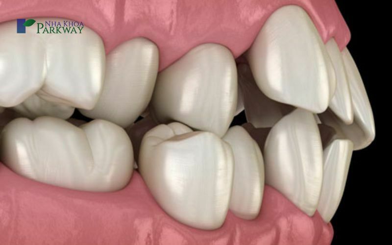 Cách để có thể nhận biết được răng bị hô hàm trên