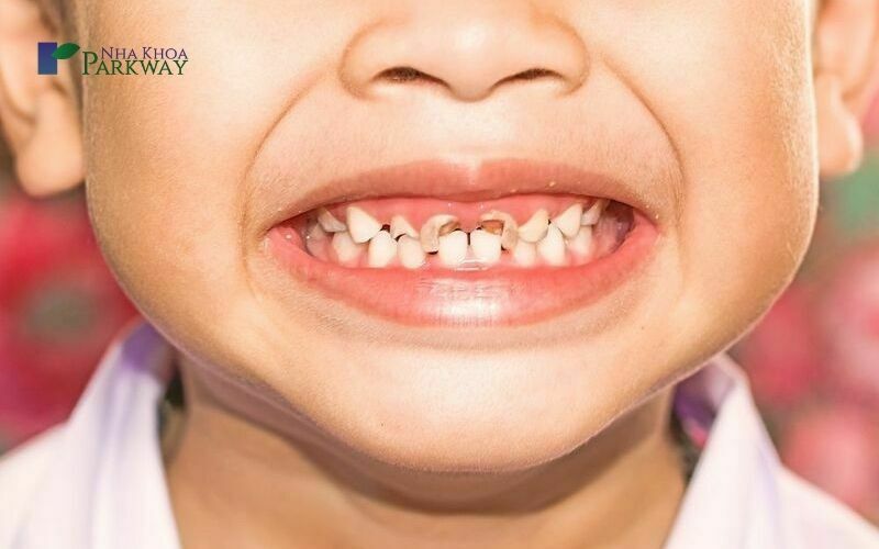 Cách chữa sâu răng cho trẻ