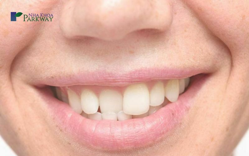 Đối tượng nào có thể áp dụng phương pháp niềng 1 cái răng? 