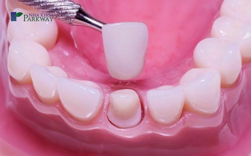 Nguyên nhân khiến làm răng sứ bị đau nhức