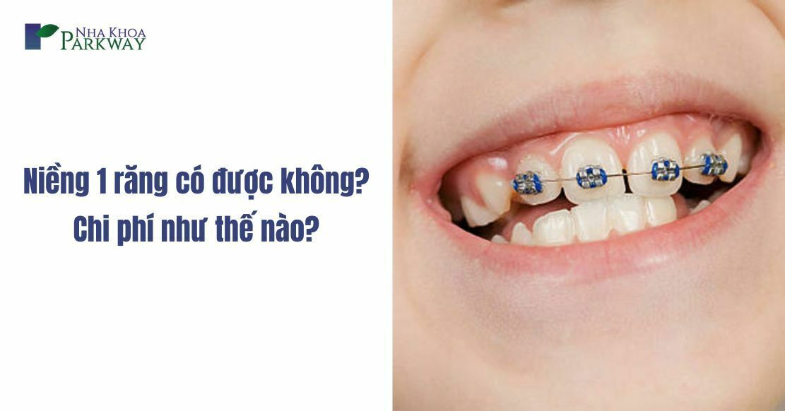 Niềng 1 răng có được không? Chi phí như thế nào?