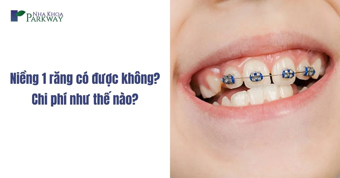 Niềng 1 răng có được không? Chi phí như thế nào?