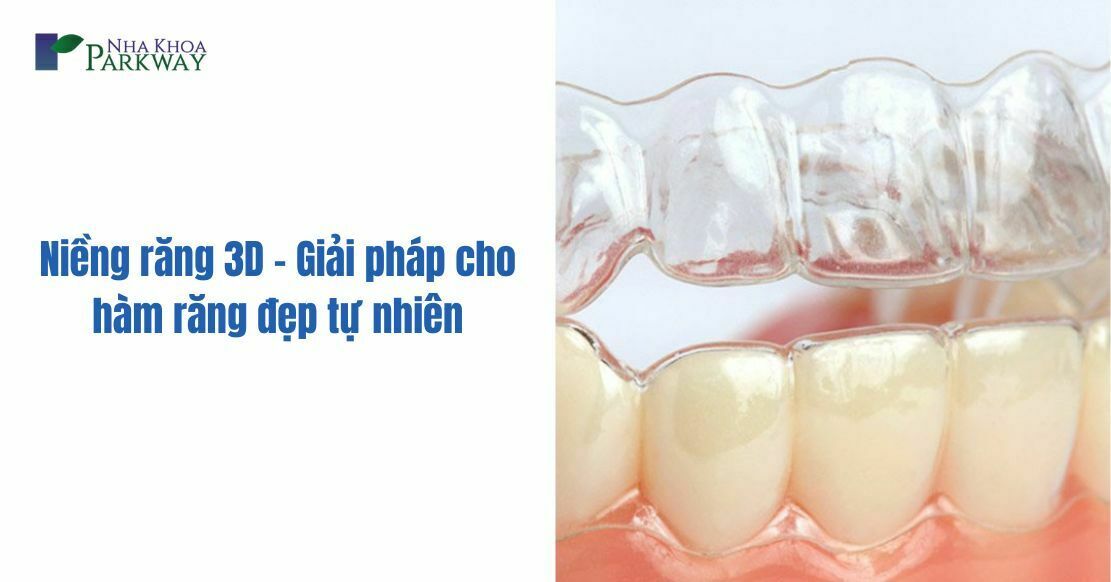 Niềng răng 3D - Giải pháp cho hàm răng đẹp tự nhiên