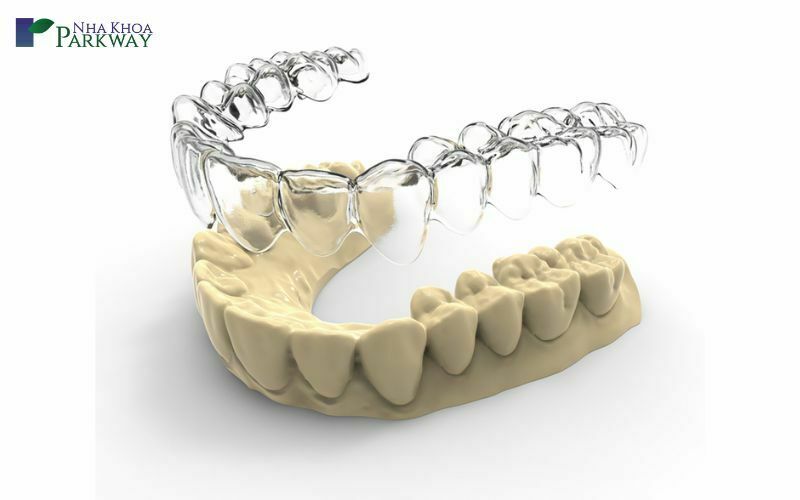 Niềng răng 3D là gì?