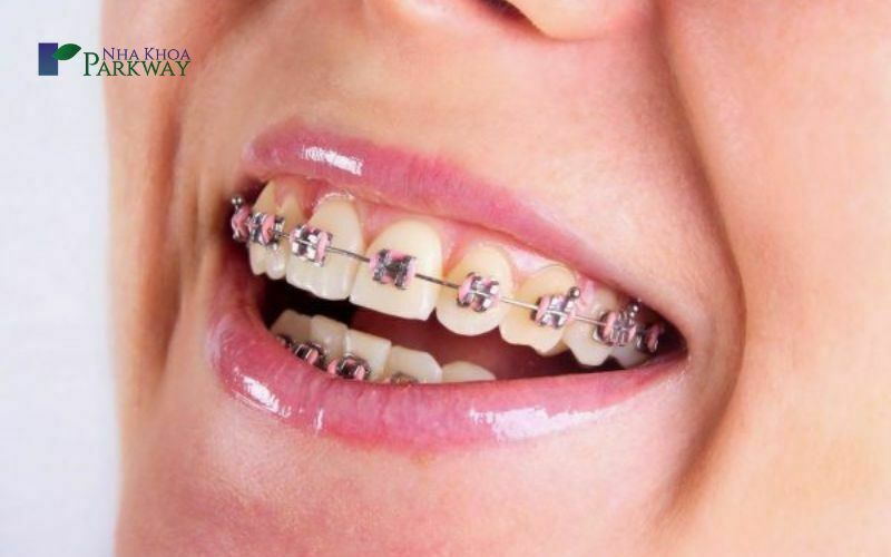 Có đau không khi niềng răng bị hô hàm trên?