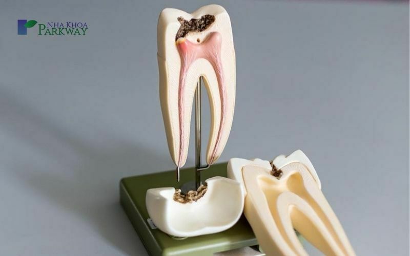 Răng có thể bị chết tủy