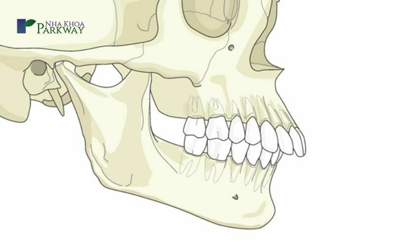 Răng hô hàm trên là như thế nào?