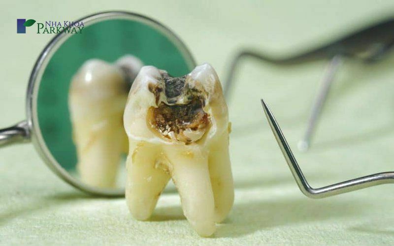 Một vài lưu ý chăm sóc răng sau khi nhổ răng sâu số 8