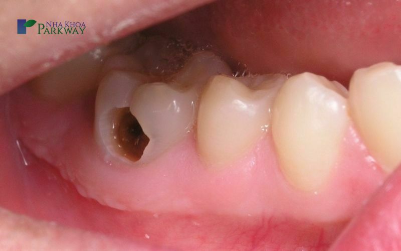 Độ tuổi trẻ em mọc răng hàm là khi nào?