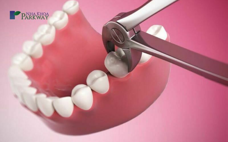 Tác hại của việc răng hàm của trẻ bị sâu 