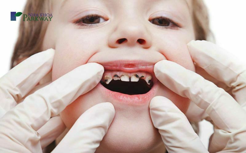 Những nguyên nhân, lý do khiến cho bé bị sâu răng hàm