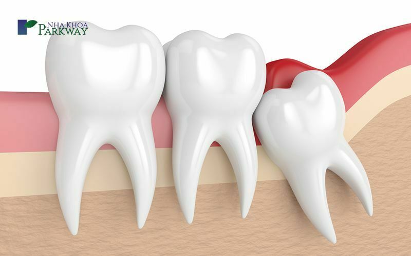 Điều trị khi viêm chân răng giai đoạn nhẹ