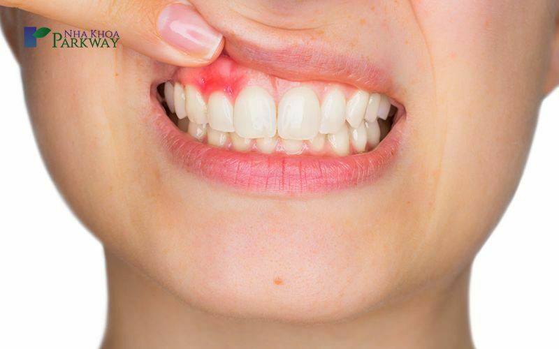 Viêm chân răng là gì? 