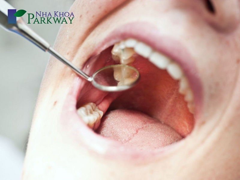 4 Giai đoạn của viêm chân răng