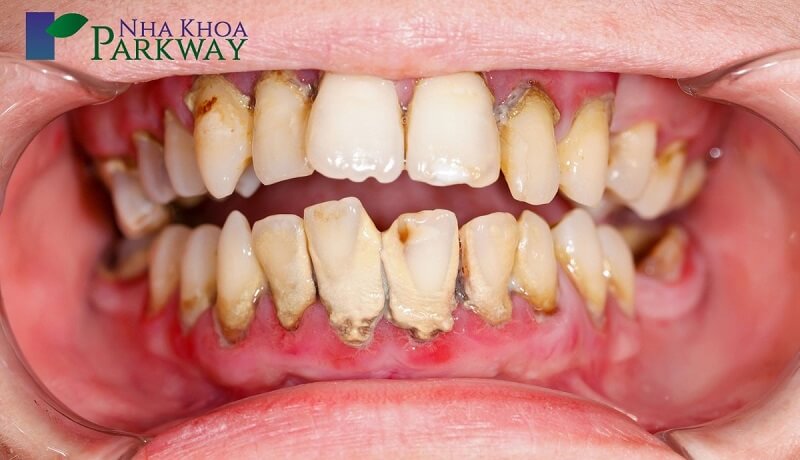 Nên thăm khám bác sĩ nha khoa định kỳ để kiểm tra tình trạng răng miệng của bạn