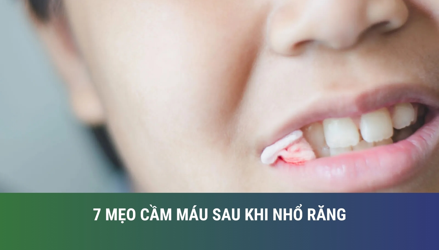 7 mẹo cầm máu sau khi nhổ răng hiệu quả