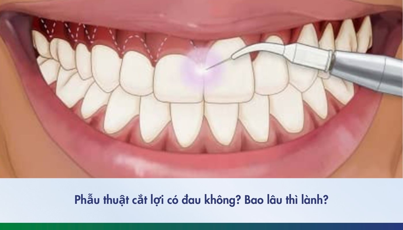 Những điều cần biết khi phẫu thuật cắt lợi