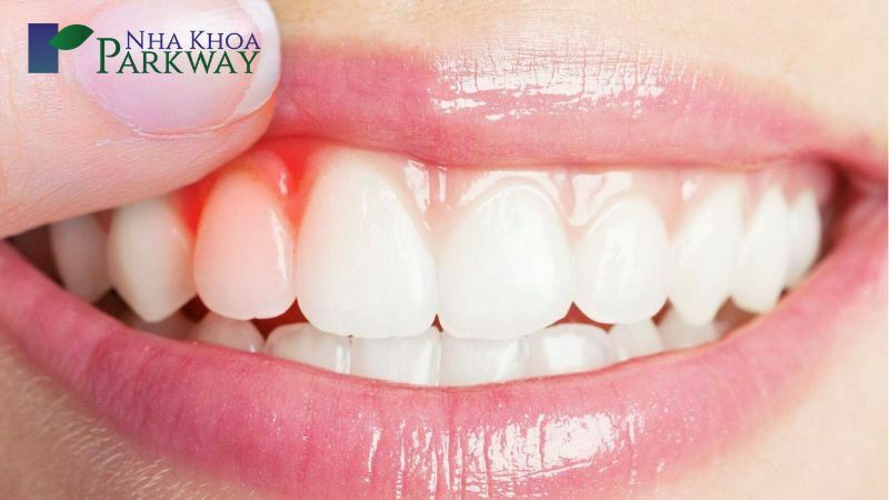 Viêm lợi cũng là một trong những hậu quả nếu như bọc răng sứ không chất lượng