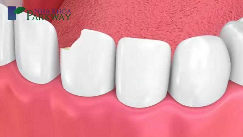 Vỡ răng sứ là một điều rất dể xảy ra nhiều bọc răng sứ với vật liệu kém chất lượng