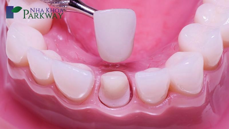 Quy trình bọc răng sứ 1 chiếc chuẩn nha khoa