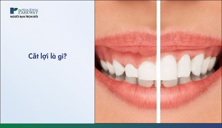 Cắt lợi làm dài thân răng