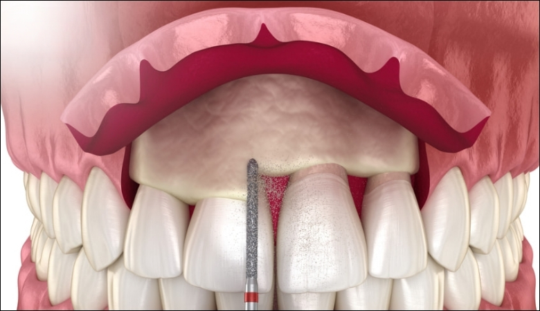 Cắt lợi giúp làm dài thân răng, mang lại nụ cười hài hòa