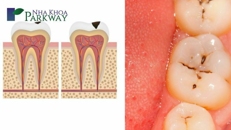 Điều trị tủy răng là gì?