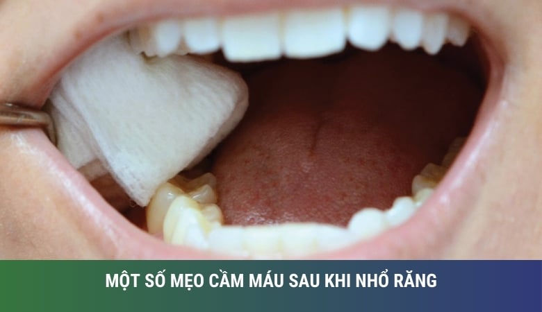 Những mẹo cầm máu sau khi nhổ răng hiệu quả - 1